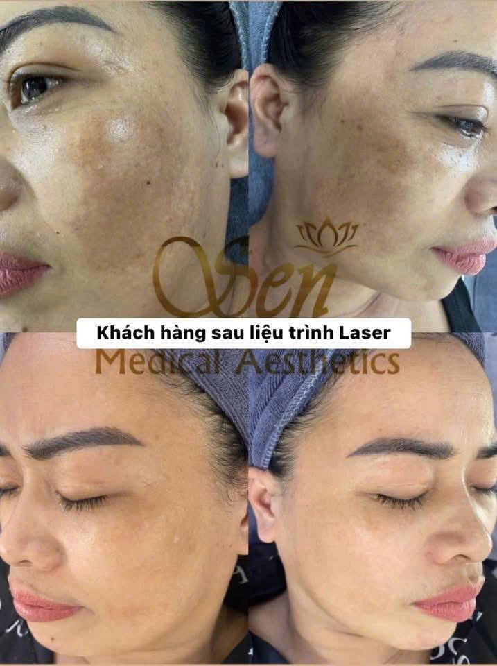 Khách hàng sau liệu trình Laser cải thiện nám tại Thẩm Mỹ Sen NB