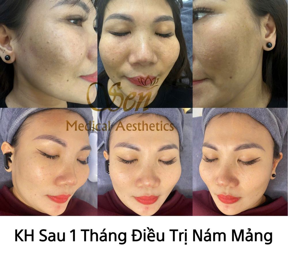 Khách hàng sau 1 tháng cải thiện nám mảng