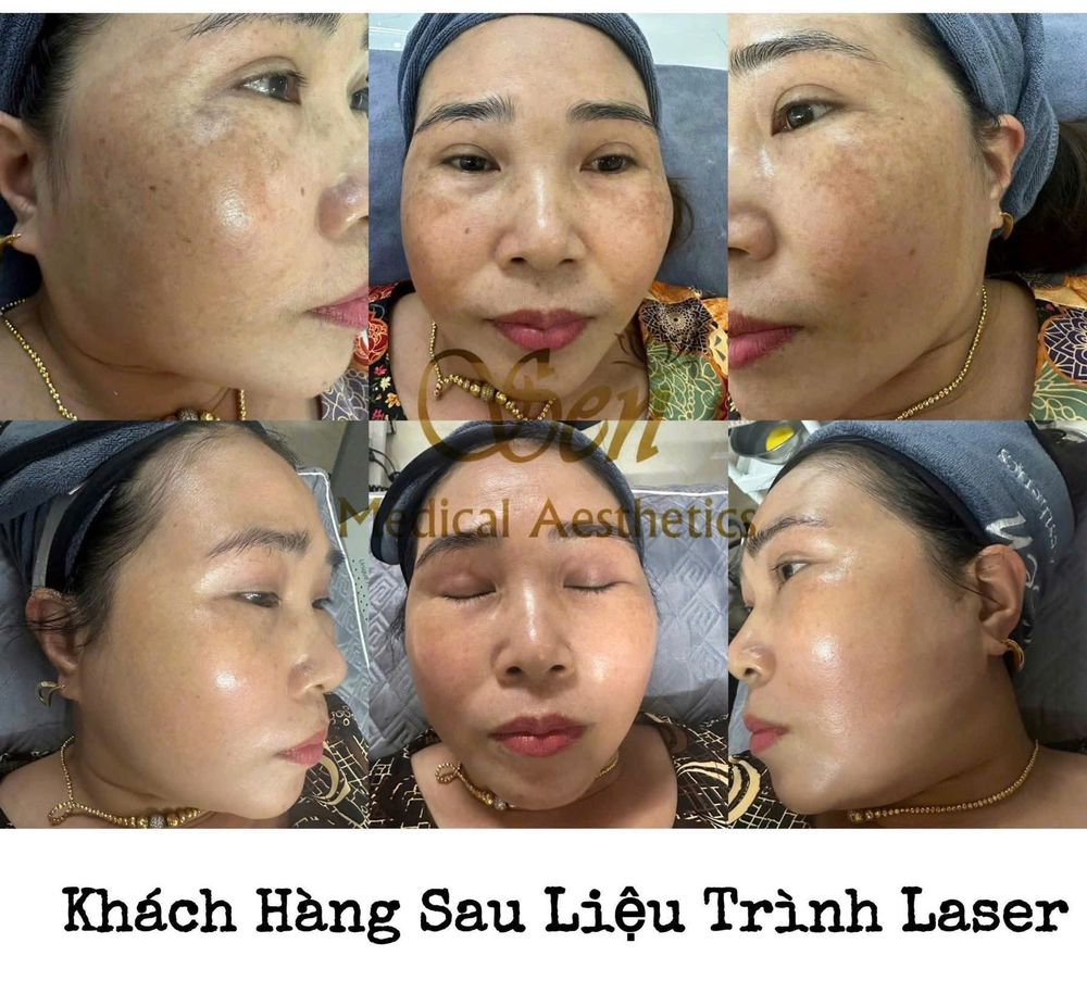 Khách hàng sau liệu trình Laser cải thiện nám