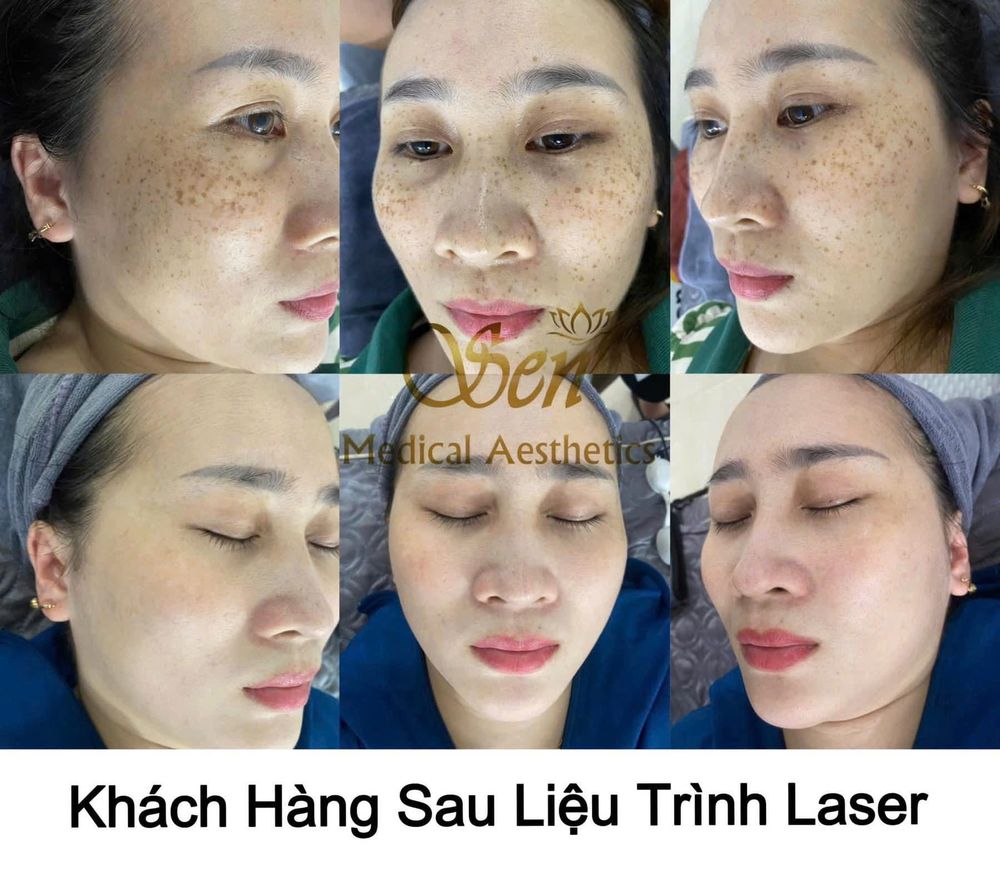 Khách hàng chăm sóc tàn nhang sau liệu trình Laser