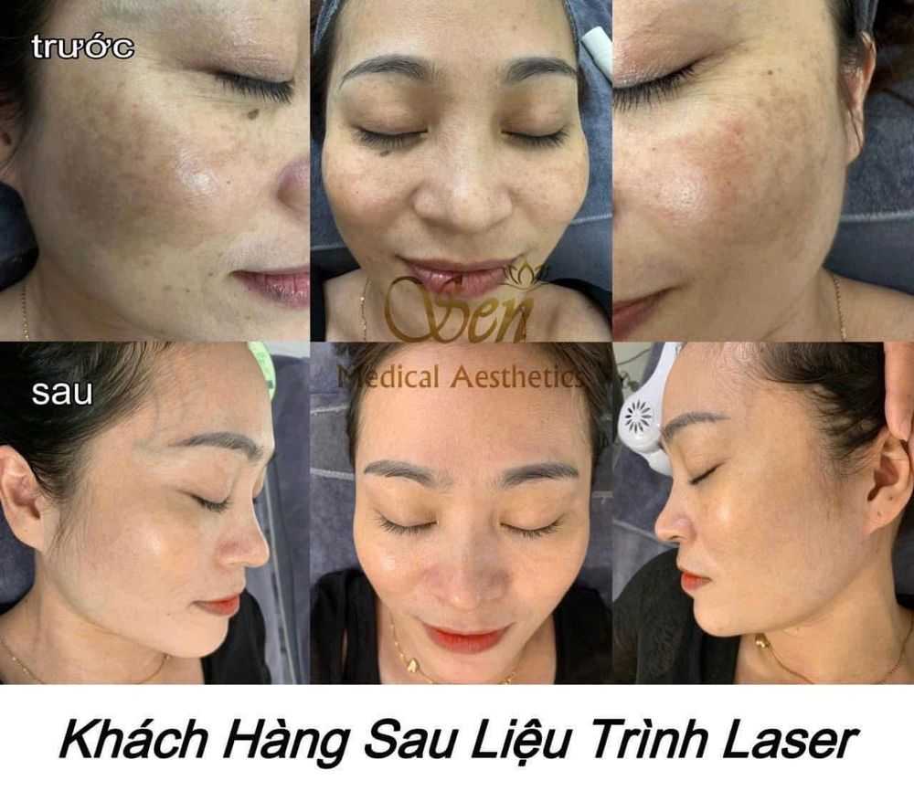 Khách hàng trải nghiệm liệu trình tại Thẩm Mỹ Sen NB